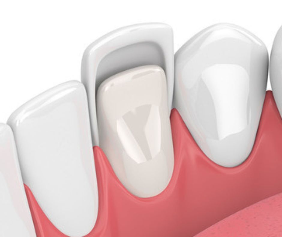 Dental Veneer Illustration image