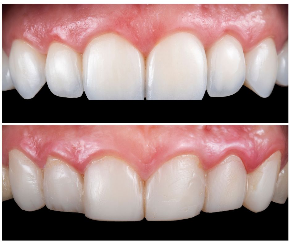 Dental Veneer image beford and after