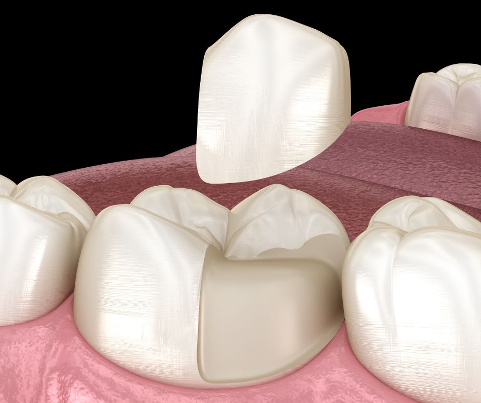 Dental Inlays and Onlays image illustration